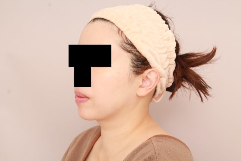 ほほ顎脂肪吸引のモニター様3か月後