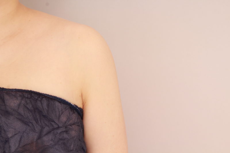 二の腕、肩の脂肪吸引3か月後