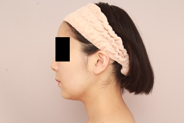 お顔の脂肪吸引 術後1か月の経過