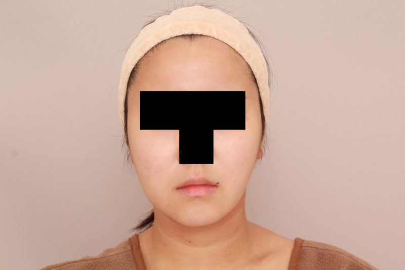 ほほ顎脂肪吸引でますます美人さんに2か月後