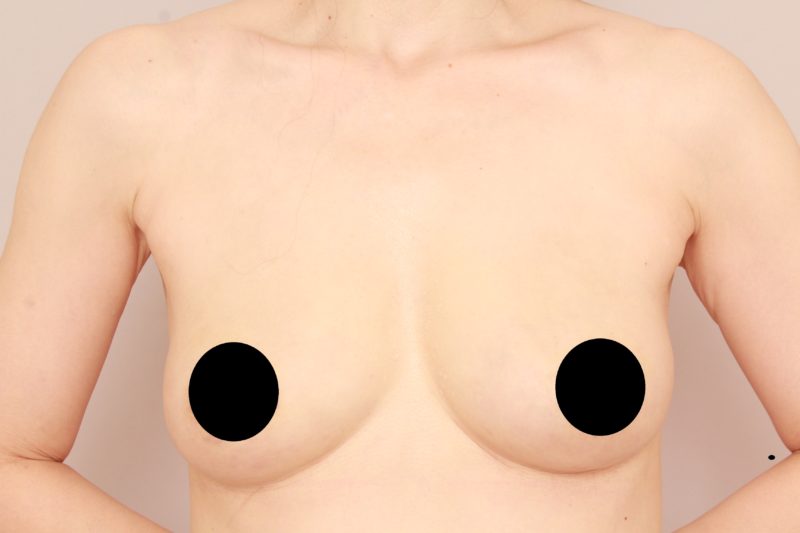 シリコンバック抜去&コンデンスリッチ豊胸モニター様1か月後