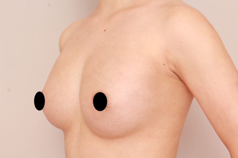 コンデンスリッチ豊胸のモニター様3か月後