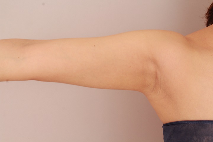 二の腕・肩の脂肪吸引　術後3ヵ月の経過