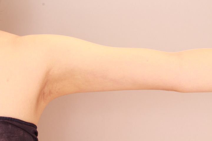 二の腕・肩の脂肪吸引 術後3ヵ月の経過