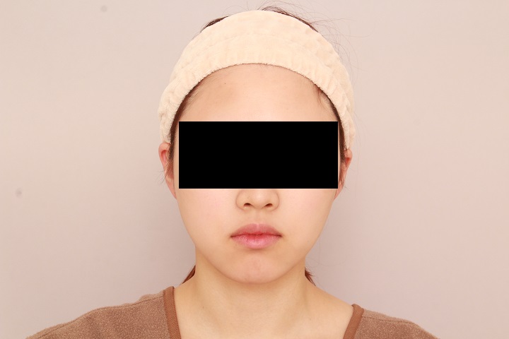 お顔の脂肪吸引 術後6カ月の経過