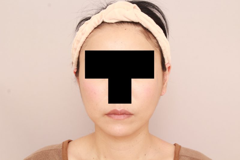 ほほ顎脂肪吸引のモニター様6か月後