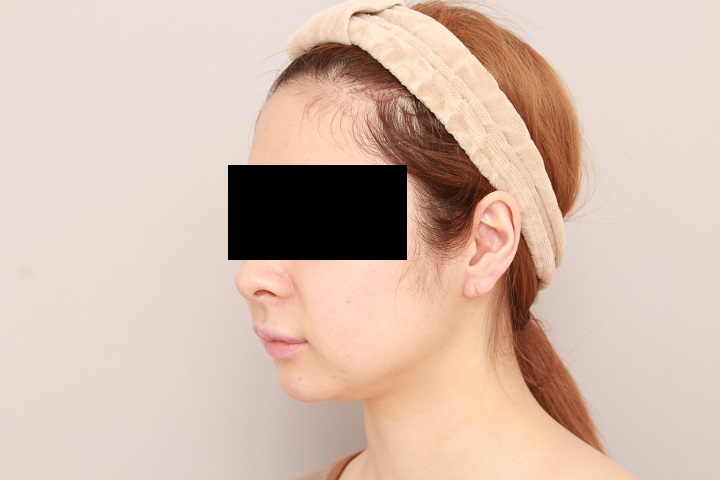 お顔の脂肪吸引 術後6ヵ月の経過