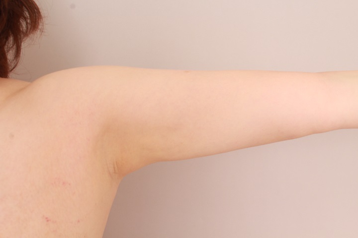 二の腕・肩の脂肪吸引 術後6カ月の経過