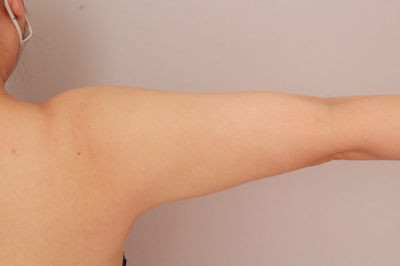 二の腕、肩のモニター様6か月後