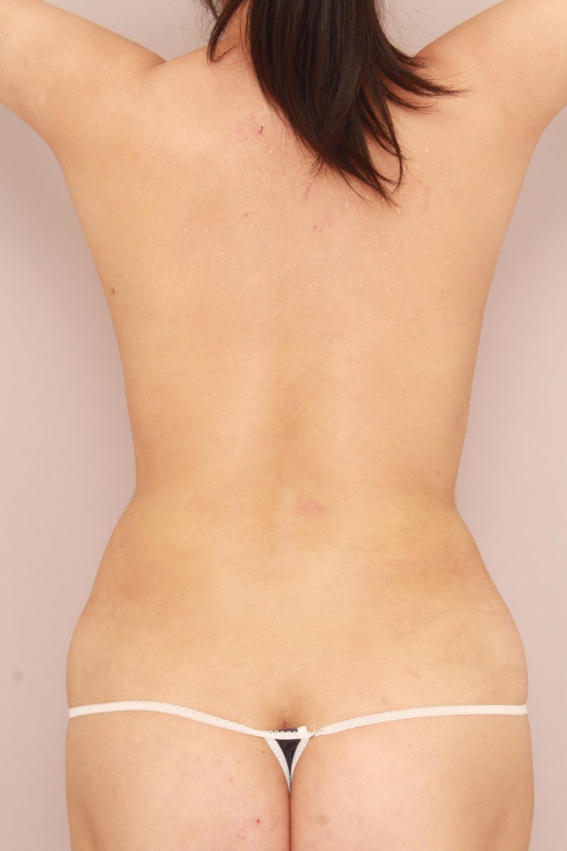 お腹全体、胸下、腰の脂肪吸引3か月後