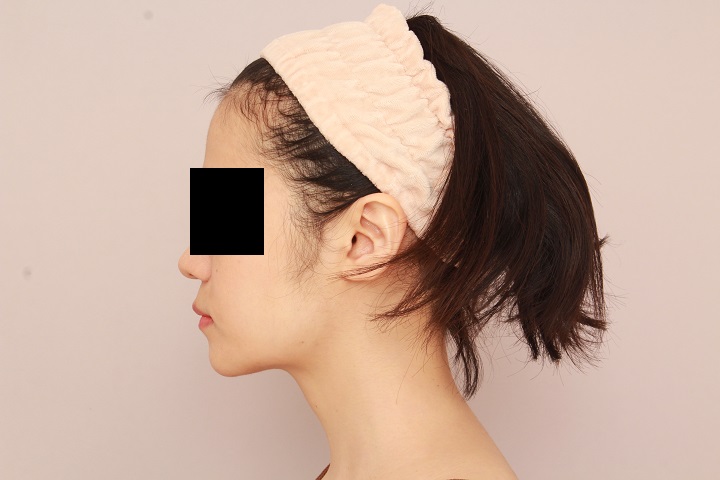 お顔の脂肪吸引　術後6ヵ月の経過