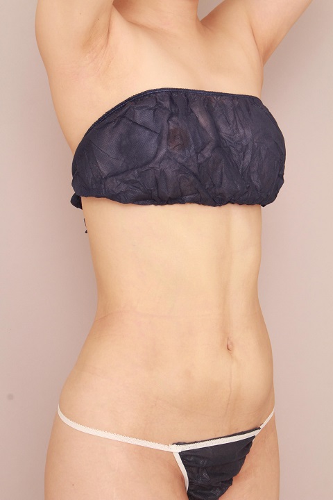 お腹・腰の脂肪吸引　術後3ヵ月の経過