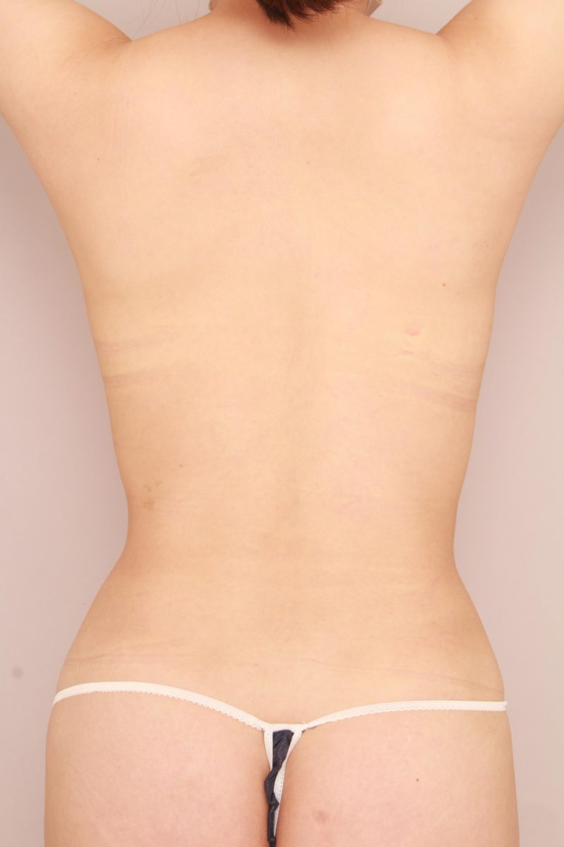 お腹、腰の脂肪吸引3か月後