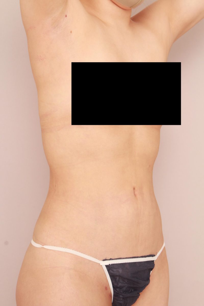 お腹、腰の脂肪吸引3か月後