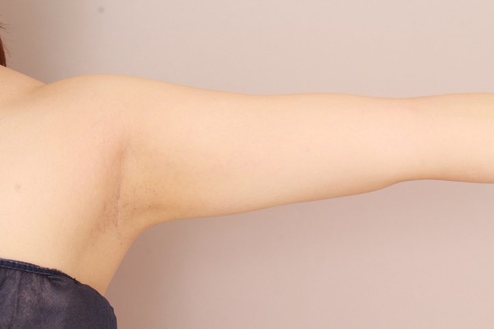 二の腕・肩の脂肪吸引　術後3カ月の経過