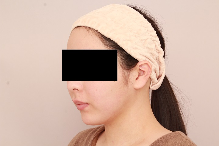 お顔の脂肪吸引　術後1ヵ月の経過