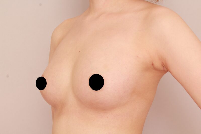 コンデンスリッチ豊胸でふっくら美バスト♡