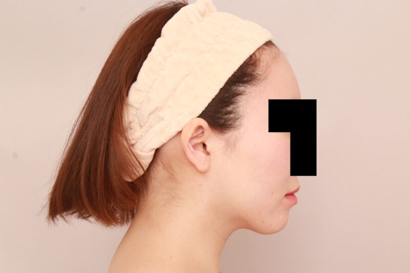 ほほ顎脂肪吸引3か月後