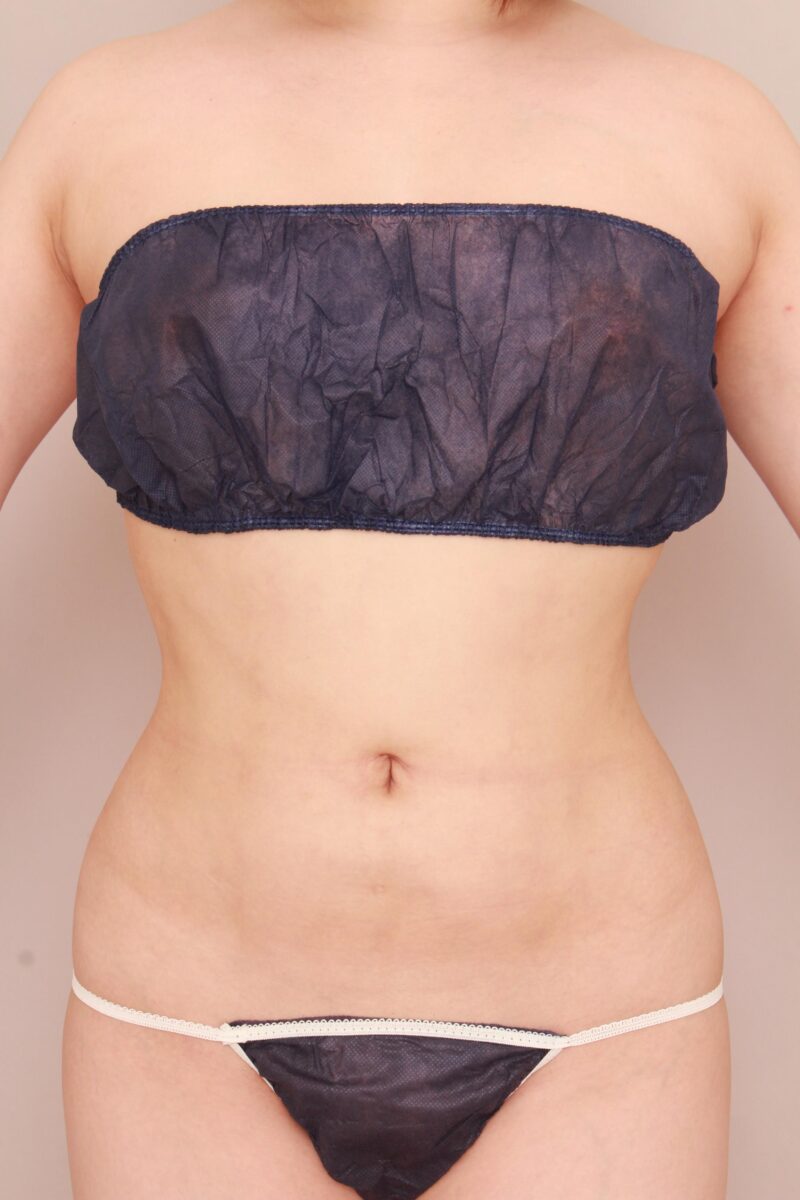 みんなで目指そう峰不二子♡お腹、腰の脂肪吸引3か月後