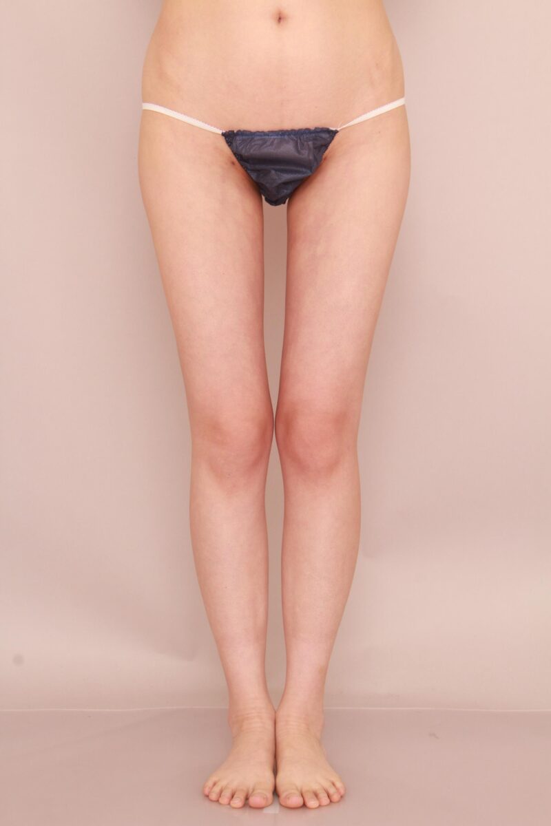 やせ型の方の太もも全周、お尻の脂肪吸引1か月後