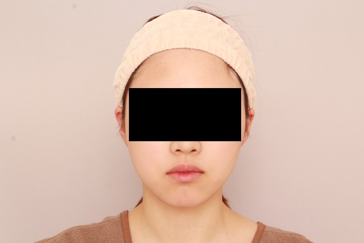 お顔の脂肪吸引 術後6ヵ月の経過