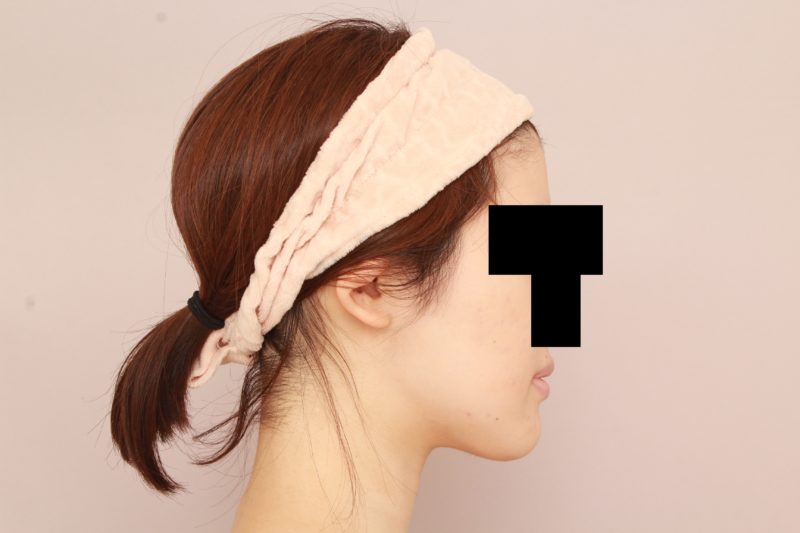 もともと痩せている方のほほ顎脂肪吸引のモニター様3か月後