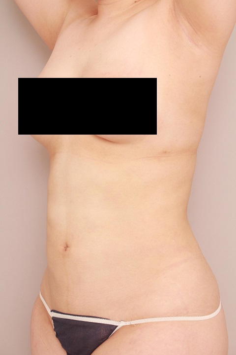 お腹・腰の脂肪吸引 術後6ヵ月の経過