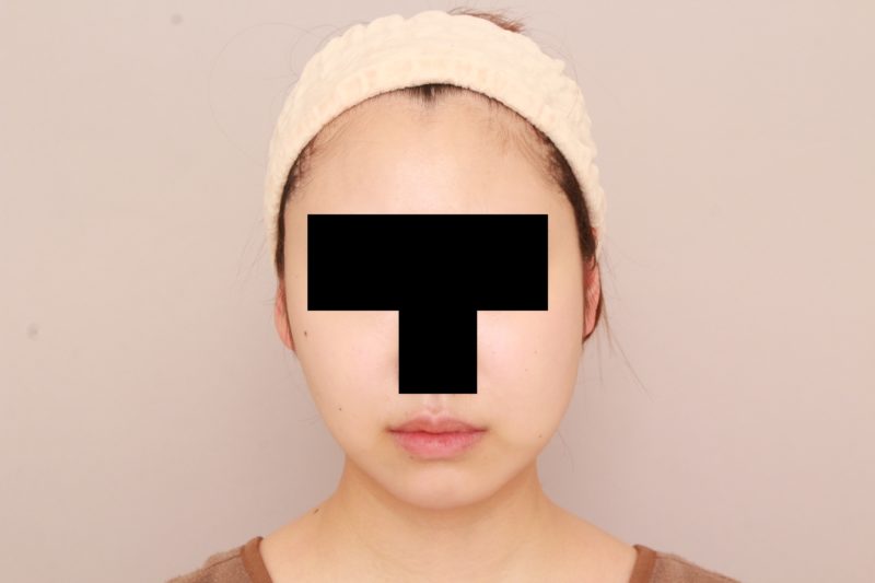 ほほ顎脂肪吸引のモニター様、ぐぐっと変わった半年後♪