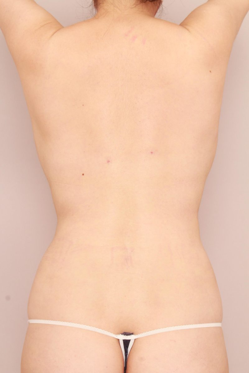 背面(肩甲骨上下、腰)の脂肪吸引のモニター様2か月後