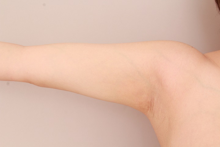 二の腕・肩の脂肪吸引 術後6ヵ月の経過