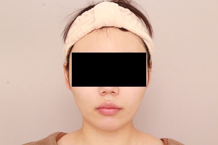 お顔の脂肪吸引 術後3ヵ月の経過