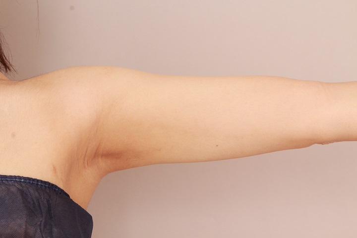 二の腕・肩の脂肪吸引 術後6カ月の経過