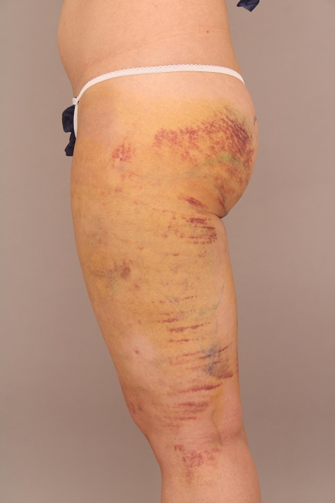 太ももの脂肪吸引 術後7日目の経過