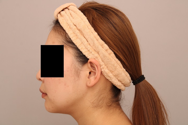 お顔の脂肪吸引 術後1ヵ月の経過