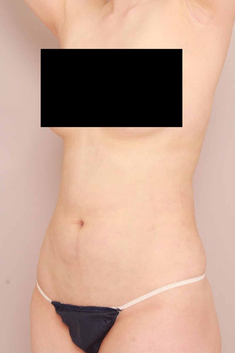 みんなで目指そう峰不二子♡お腹、腰の脂肪吸引3か月後