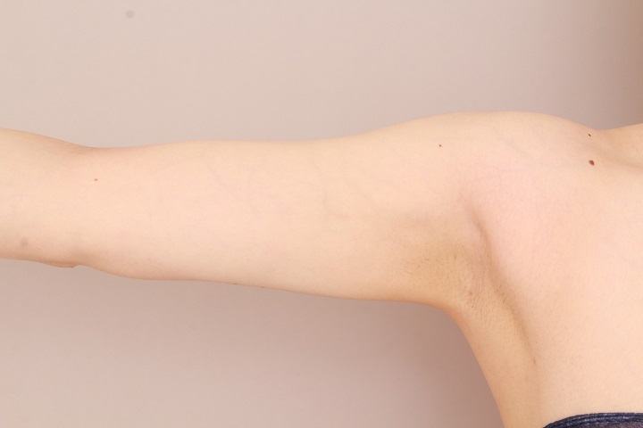 二の腕・肩の脂肪吸引 術後6ヵ月の経過