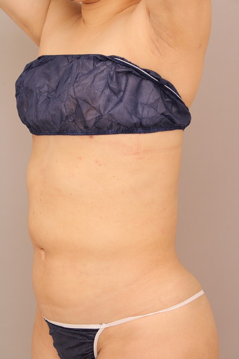 お腹・腰の脂肪吸引 術後1ヵ月の経過