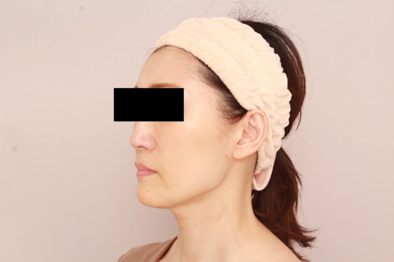 お顔の脂肪注入でエイジングケア3か月後