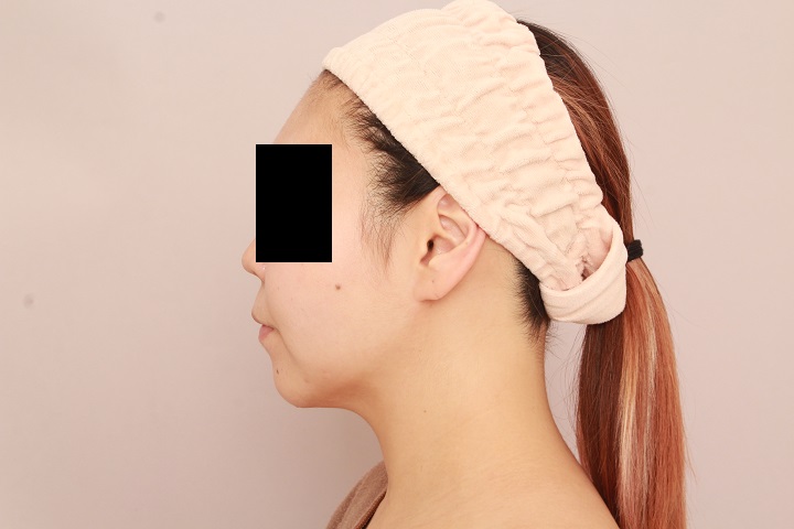 お顔の脂肪吸引 術後1カ月の経過