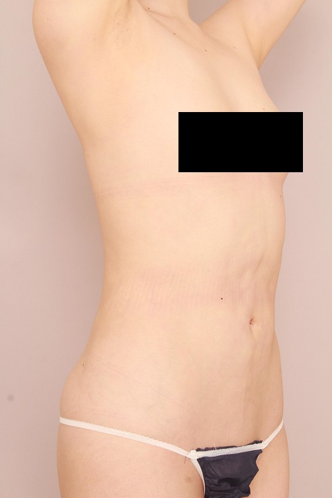 お腹・腰の脂肪吸引 術後6ヵ月の経過