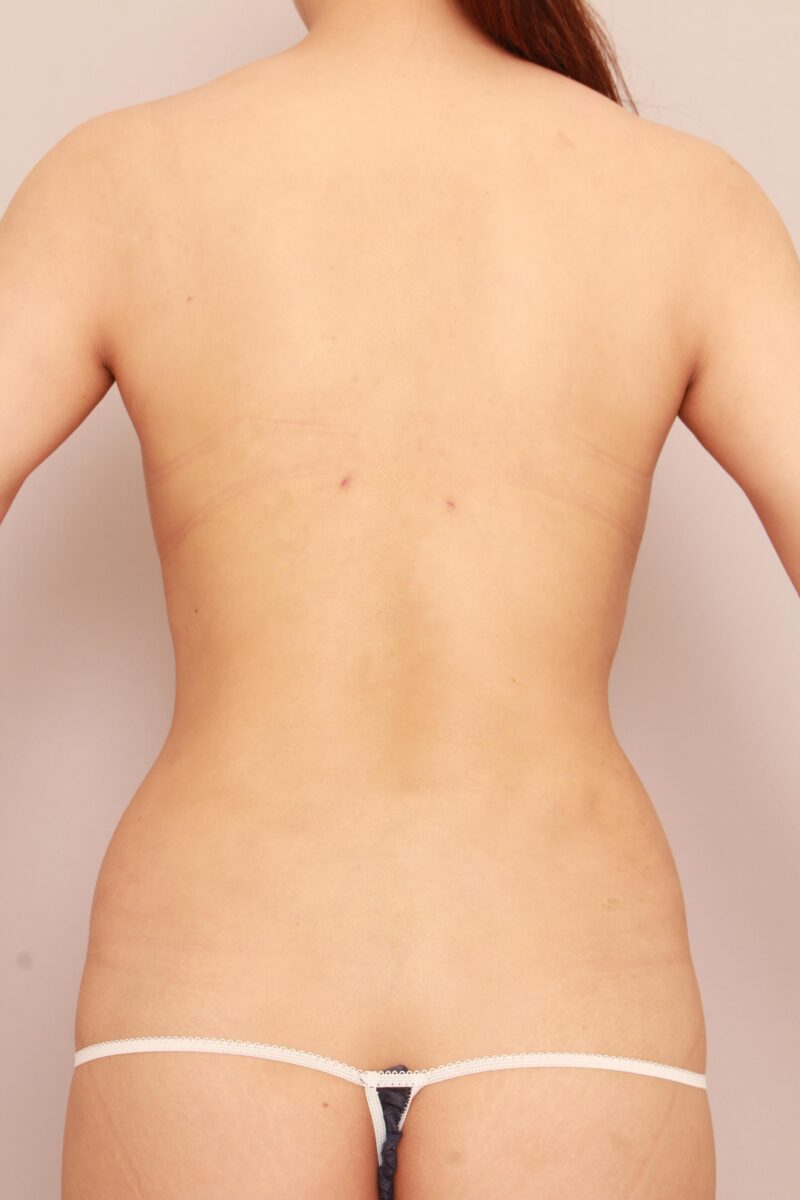 みんなで目指そう峰不二子♡お腹、腰の脂肪吸引1か月後