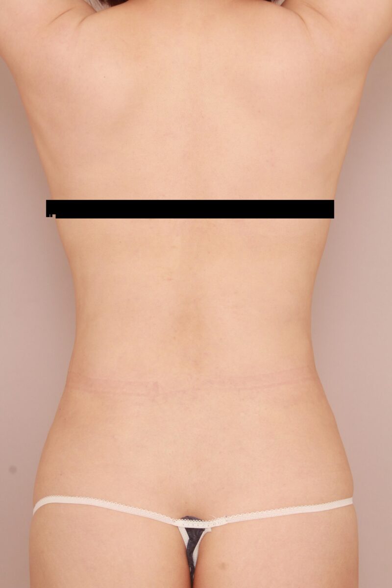 後ろ姿を若々しく!!40代のモニター様脂肪吸引半年後