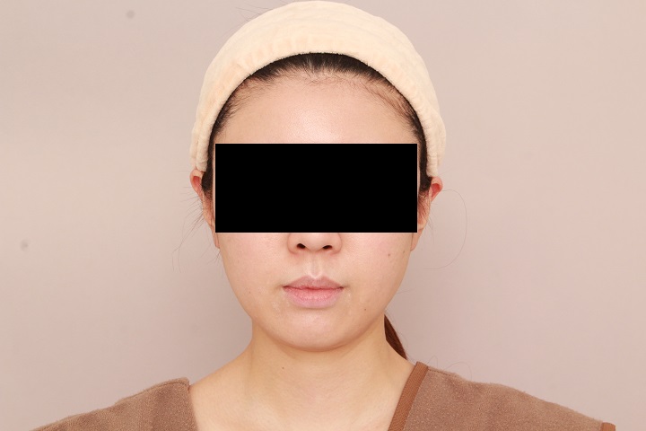 お顔の脂肪吸引　術後1カ月の経過