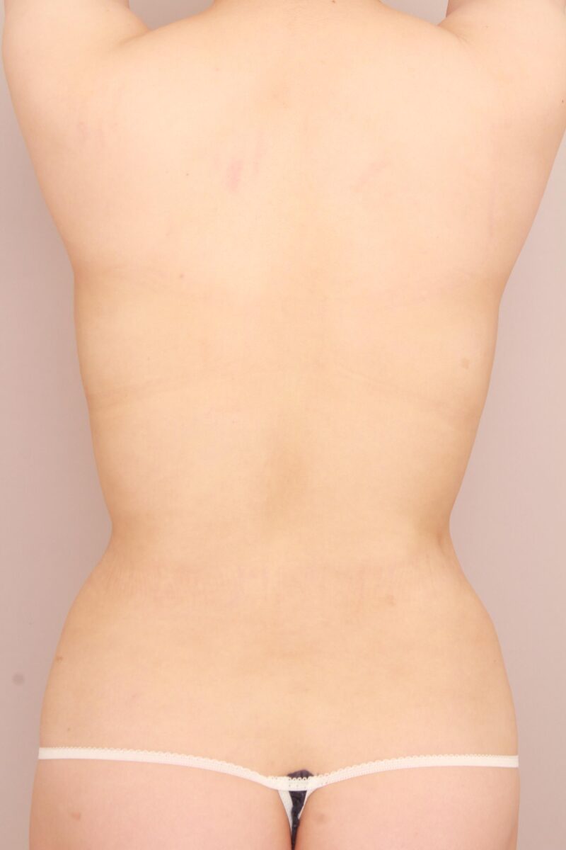 みんなで目指そう峰不二子♡(お腹、腰の脂肪吸引3か月後)