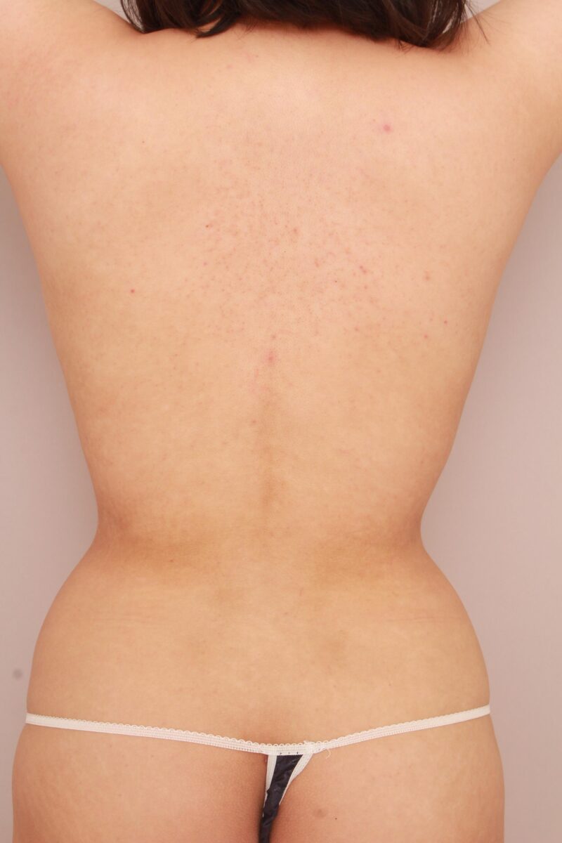 みんなで目指そう峰不二子♡お腹、腰の脂肪吸引3か月後