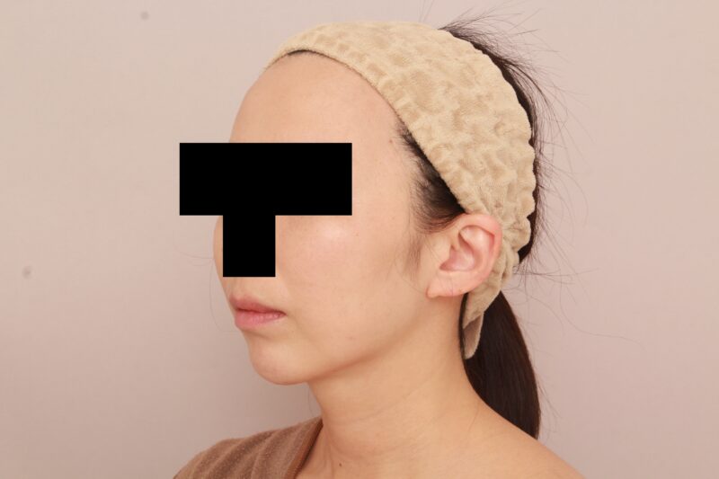 ほほ顎脂肪吸引でまっすます美人ママさんに♡3か月後