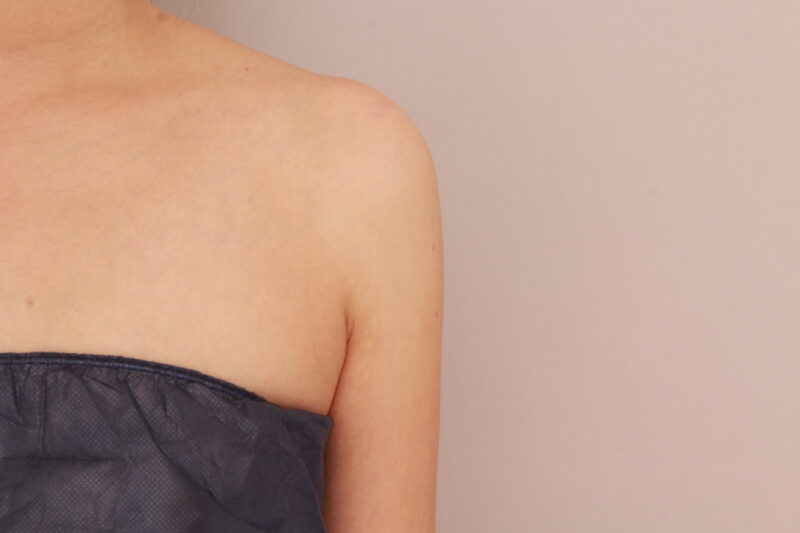 ほっそり華奢ラインの二の腕に♡１か月後