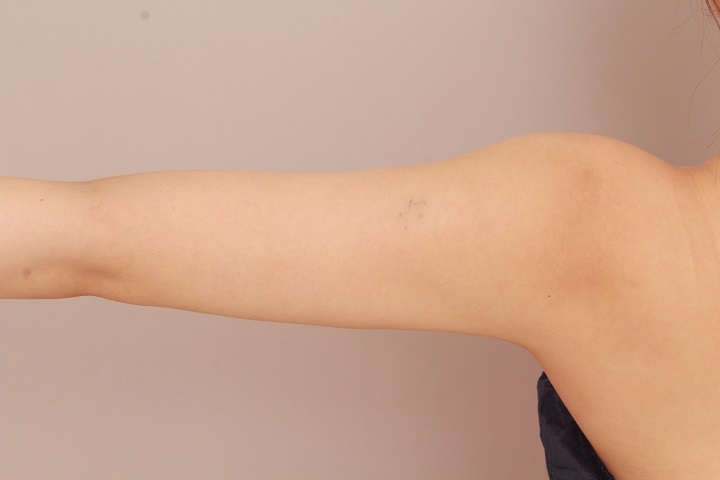 二の腕・肩の脂肪吸引　術後６ヵ月の経過