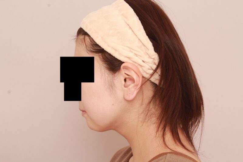 ほほ顎脂肪吸引2か月後