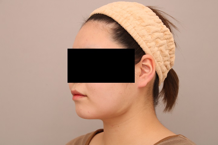 お顔の脂肪吸引　術後１ヵ月の経過